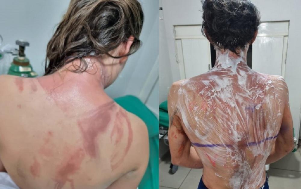 Calouros de Veterinária sofrem queimaduras de 1° e 2° grau em trote de recepção no Paraná