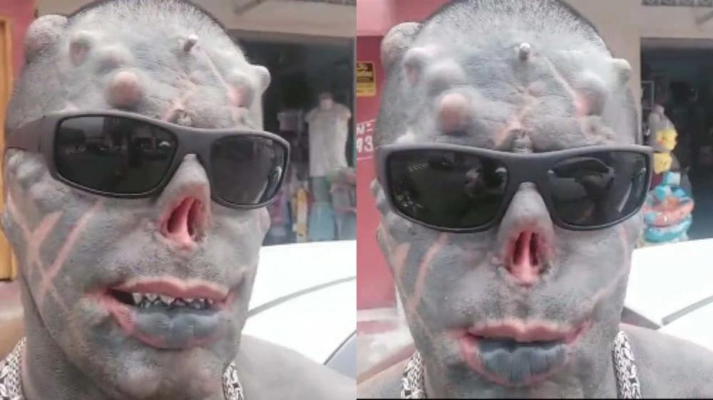 ‘Dá um jeito’, declara Diabão sobre uso de óculos após remoção de orelha