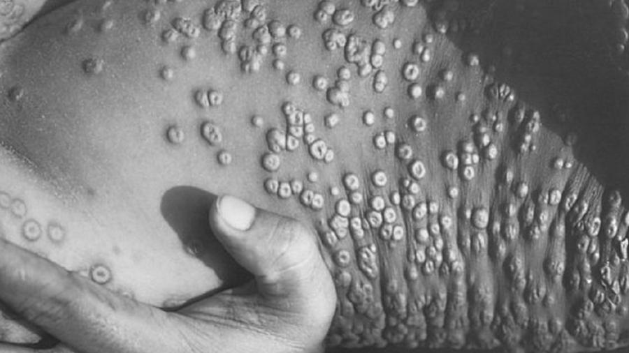 Governo divulga nota técnica com orientações sobre varíola dos macacos