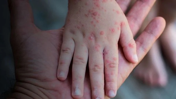 Norte Pioneiro em alerta para a varíola dos macacos