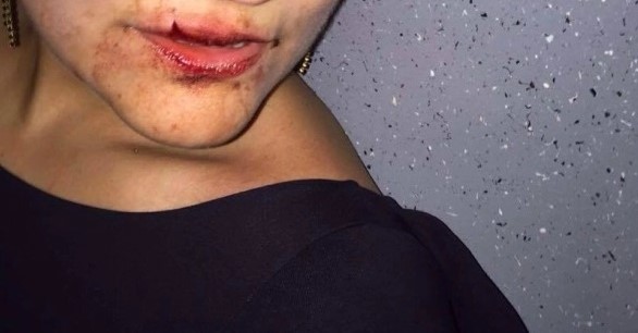 Briga entre vizinhos acaba em soco na boca e tijolada na cabeça