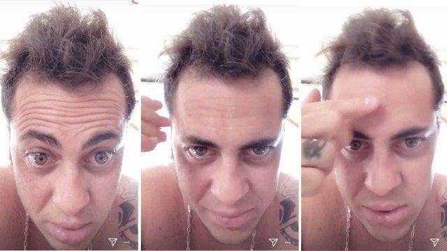 ‘Achei que ia ficar feio careca’, diz Thammy Miranda sobre transplante capilar