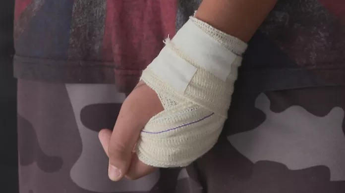 Mulher se envolve em briga e tem dedo amputado em Arapoti