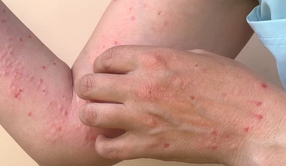 Siqueira Campos registra primeiro caso de Varíola do Macaco