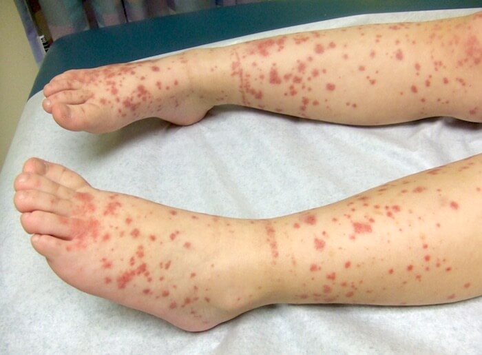 SESA emite nota sobre a Febre Maculosa no Paraná