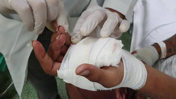 Homem vai comprar drogas e leva tiro na mão por estar devendo na biqueira