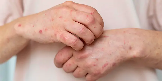 Saúde confirma caso de Monkey Pox no Norte Pioneiro