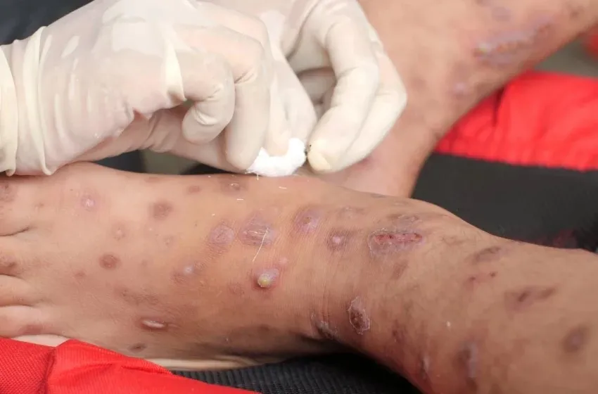 Conheça a Mpox: Sintomas, efeitos e medidas de prevenção