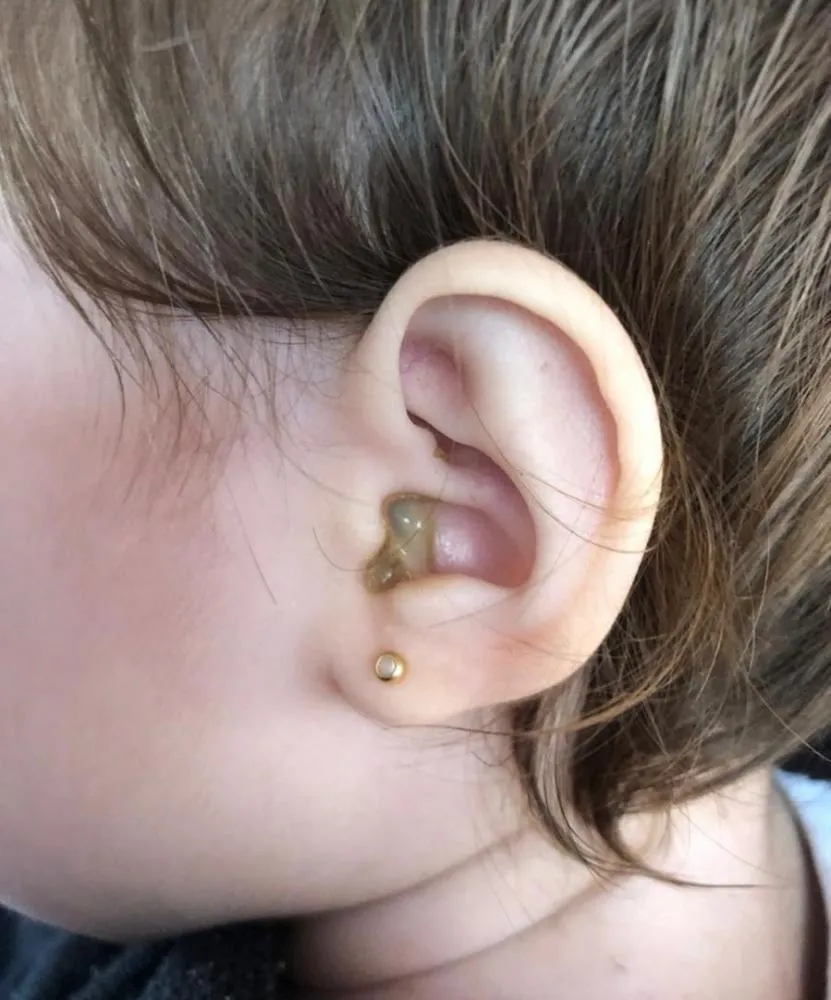 Bebê brazense precisa de cirurgia urgente para não perder a audição