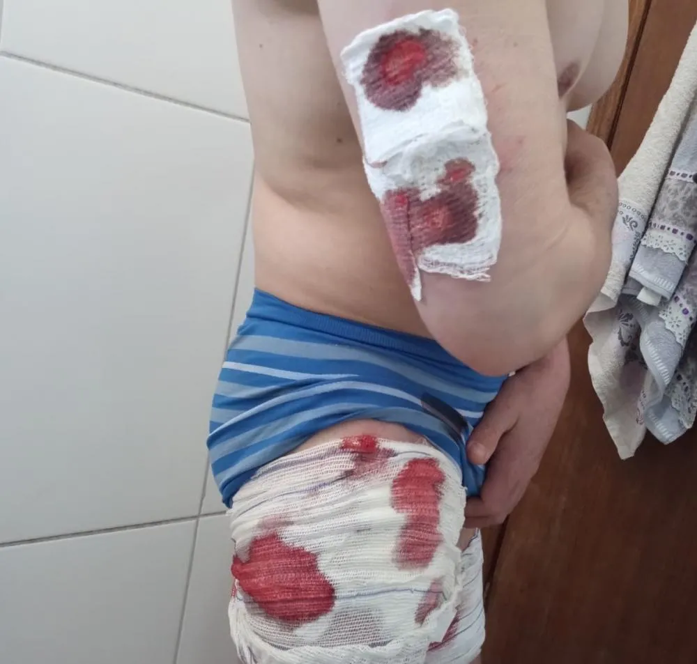 Ataque de Pit Bulls deixa três pessoas gravemente feridas em Wenceslau Braz