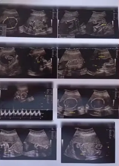 Homem vai ao médico com dor nas costas e recebe diagnóstico de gravidez no Paraná