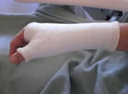 Homem quebra o braço da esposa com pedaço de pau depois da festa do Natal