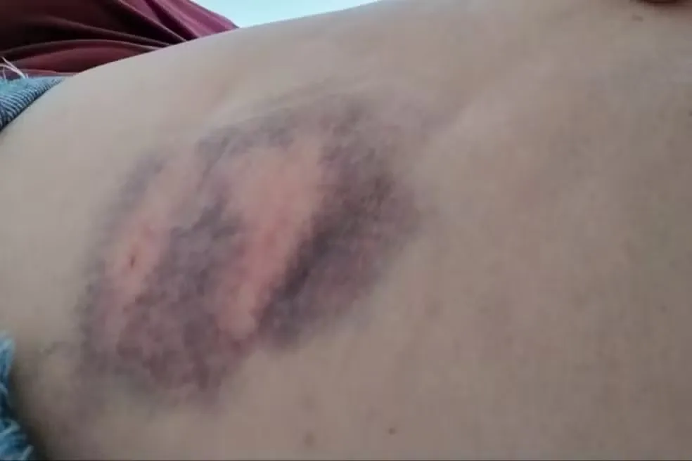 Mulher leva mordida no bumbum ao salvar neta de ataque de cachorro