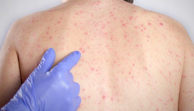 Casos de sarampo aumentam, alerta OMS
