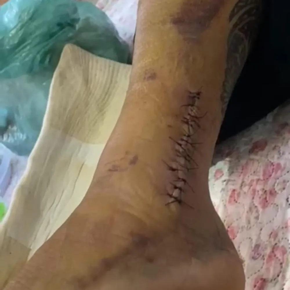 Jogador de Jaboti fratura a perna em amistoso e amigos organizam torneio beneficente para ajudá-lo