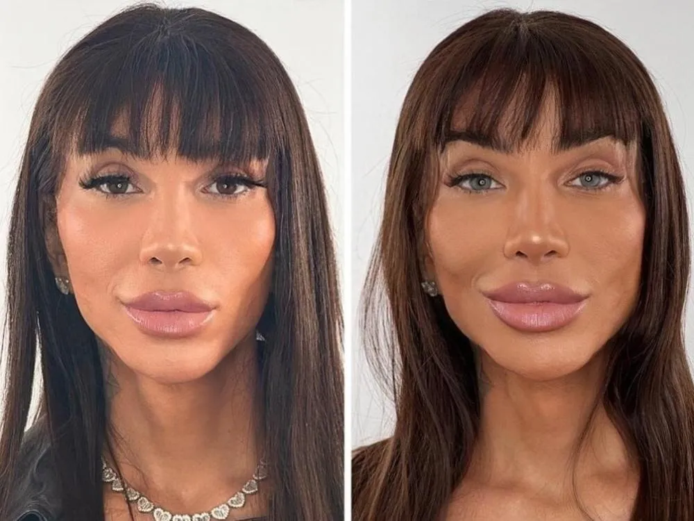 Cirurgia para alterar a cor dos olhos chama a atenção de jovens após famosas exibirem resultados nas redes sociais