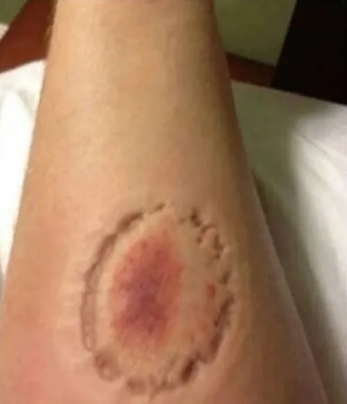 Suspeito é preso após morder e ameaçar namorada de morte