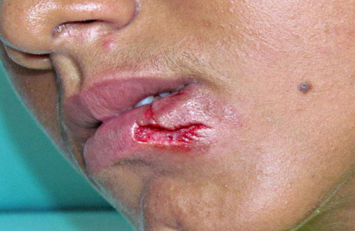 Filho arranca dente da mãe após agredi-la com chute
