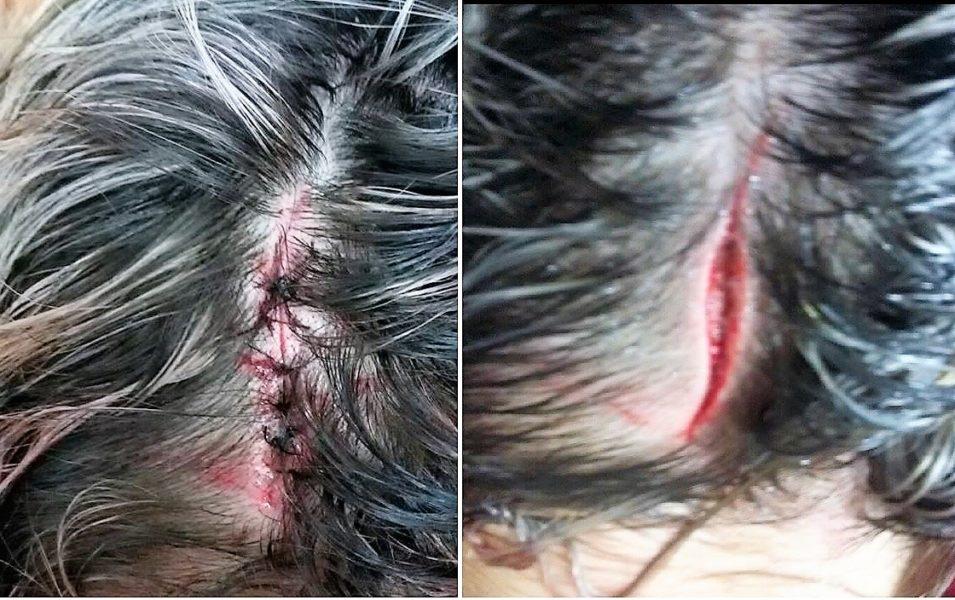 Homem é esfaqueado na cabeça durante briga de bar